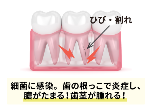 歯のひびや割れ