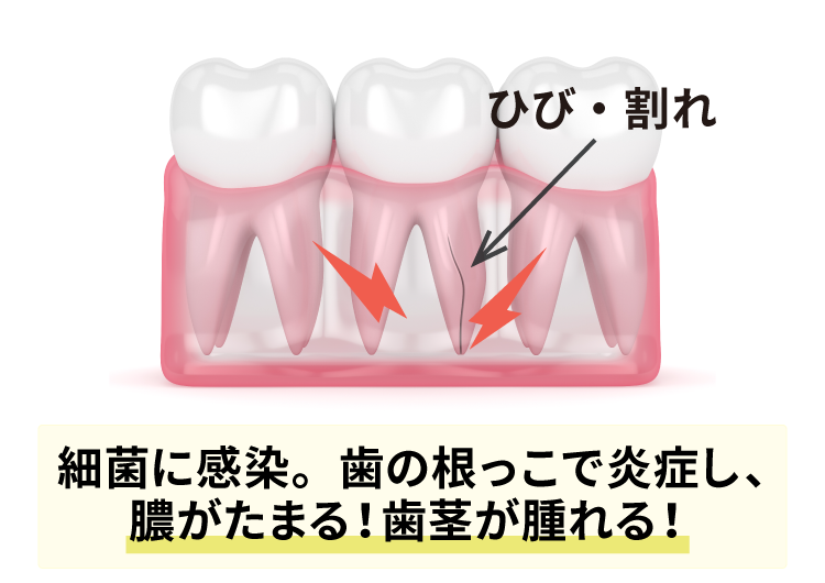 歯根が破折すると