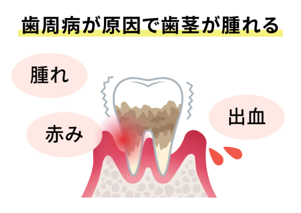 歯周病が原因で歯茎が腫れる