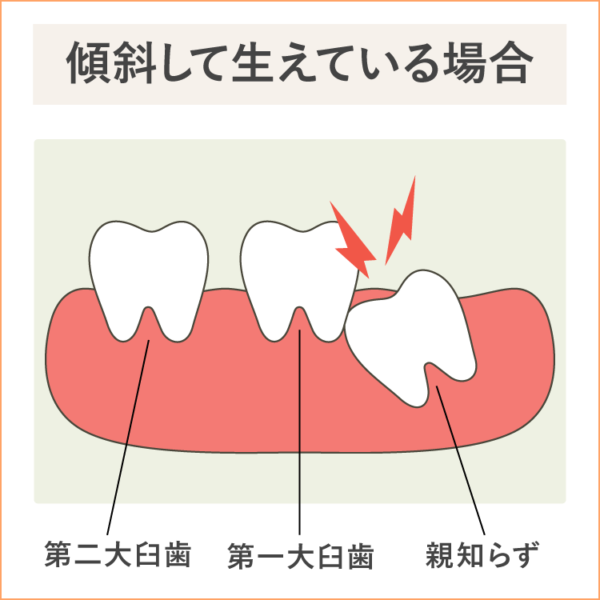 親知らずが斜めに