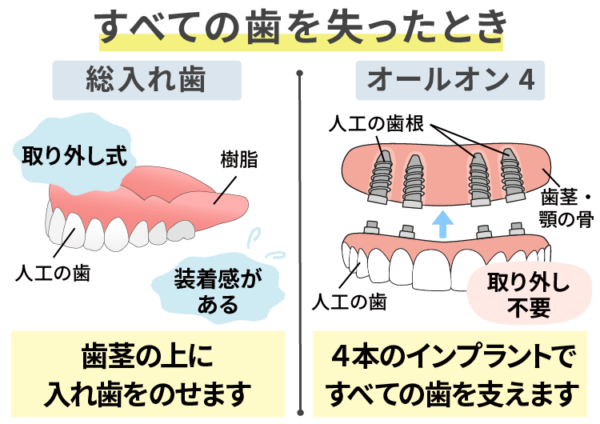 すべての歯を失った時の治療法