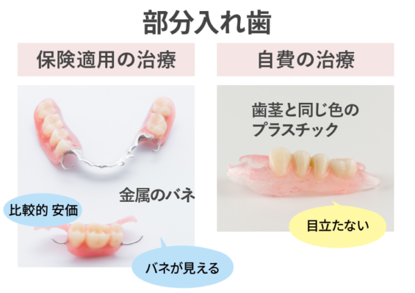 部分入れ歯