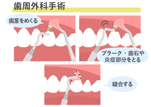 歯周病の外科手術