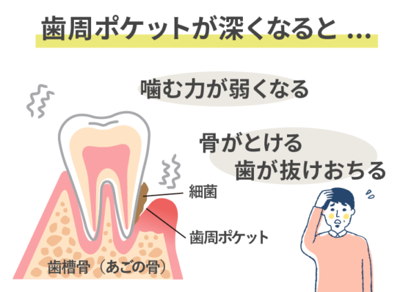 歯周病-歯周ポケット