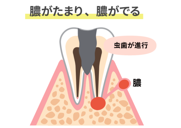 膿がたまる