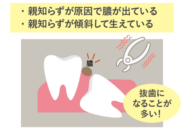 親知らずが原因