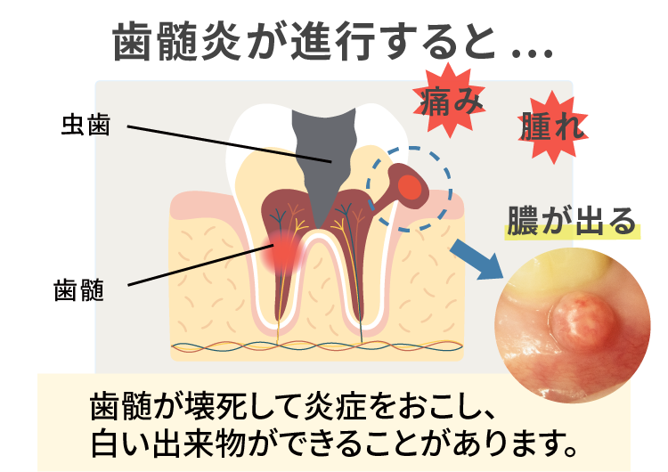 歯茎 膿がたまる | 歯茎から白い膿が出る – 歯茎の膿は切開手術が必要？痛みや費用を詳しく解説 – BYTY