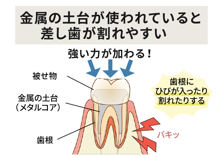 金属の土台の被せ物は割れやすい