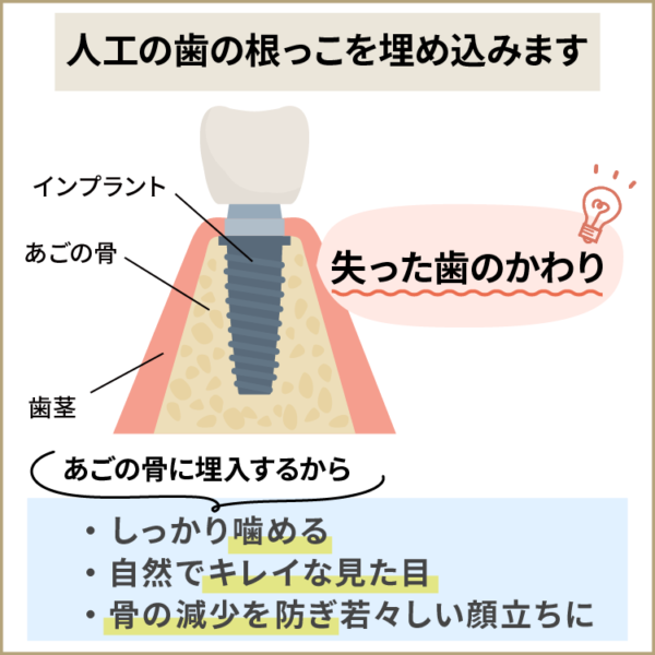 インプラントとは