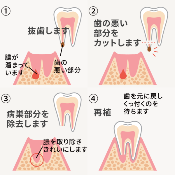 意図的再植