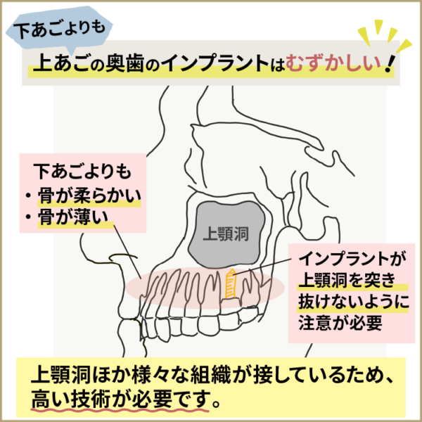 上顎の奥歯のインプラントはむずかしい