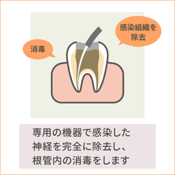 根管治療-1