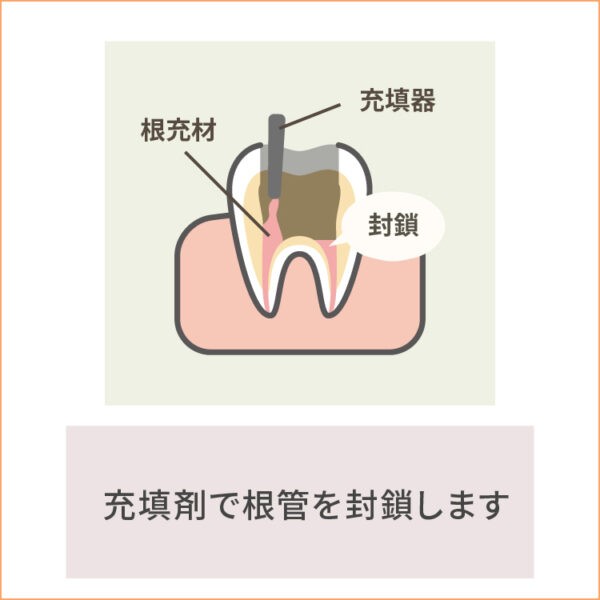 根管治療-2