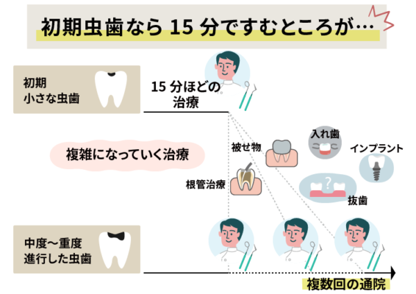 初期虫歯なら15分で済むところが