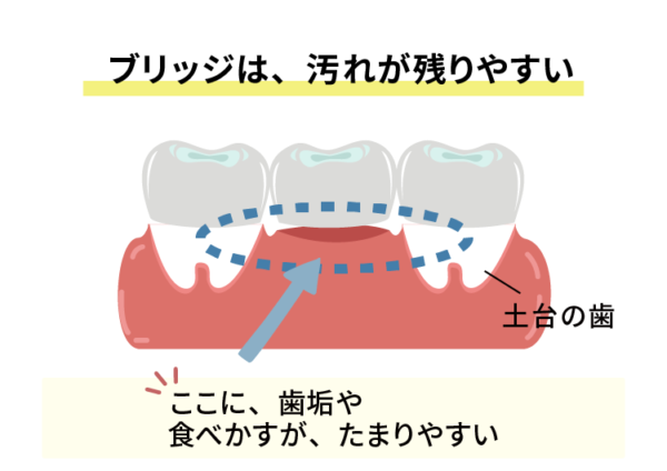 ブリッジの下の汚れ