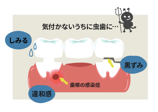 ブリッジの支台歯は虫歯になりやすい