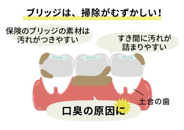 ブリッジは口臭に注意