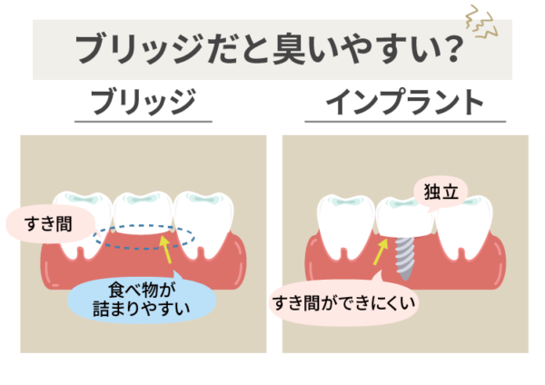インプラントは臭いにくい