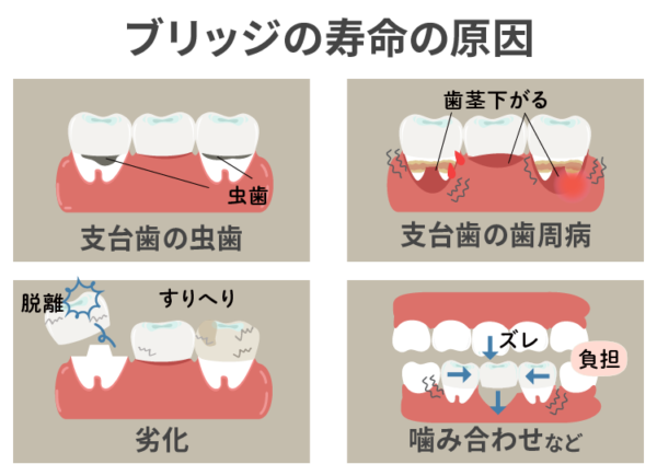 ブリッジの寿命原因