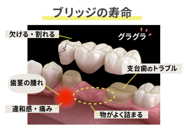 ブリッジ寿命のサイン